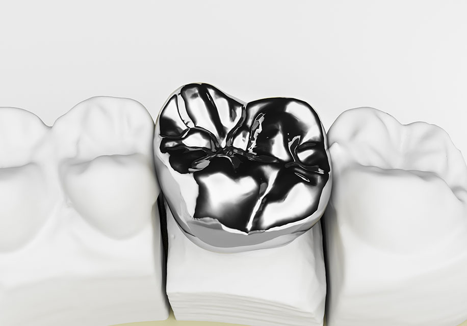 銀歯のデメリット